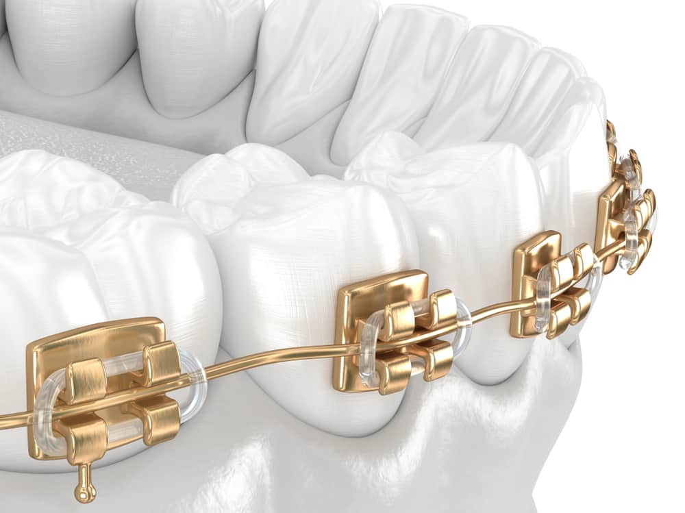 Average Gold Dental Braces Cost