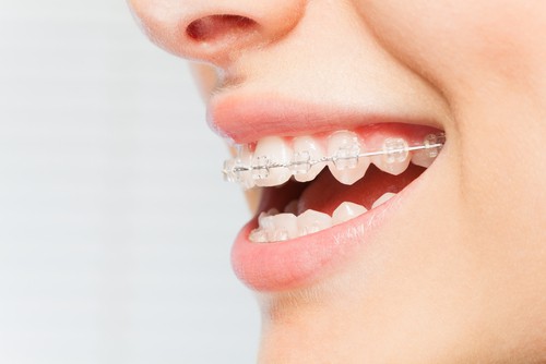 Clear (ceramic) dental braces