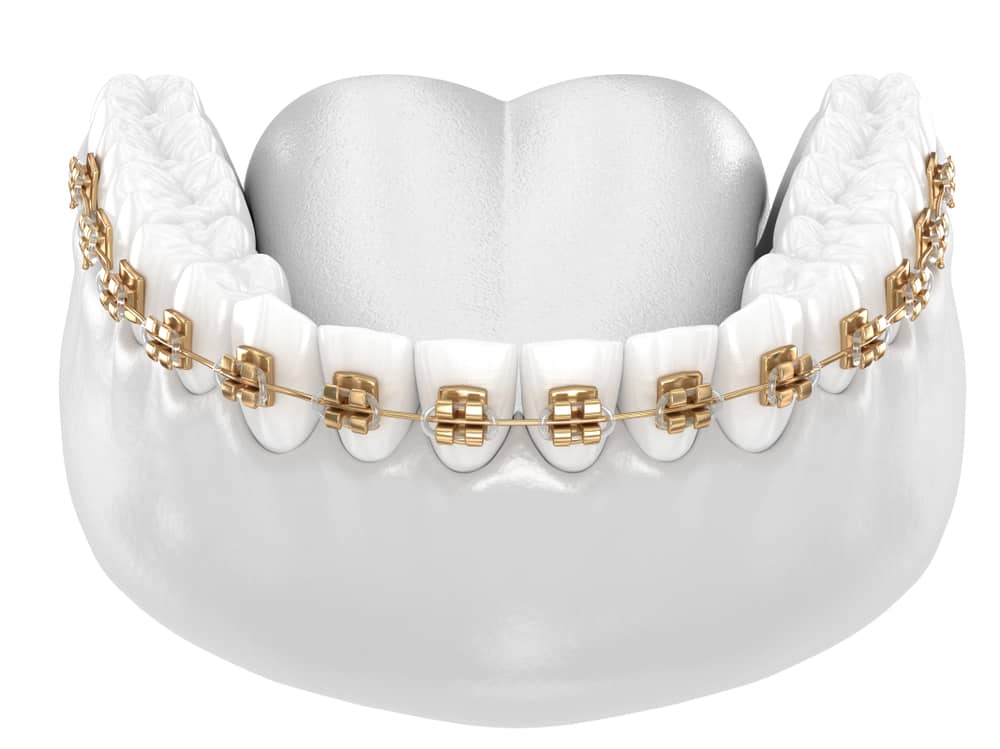Gold Dental Braces Advantages
