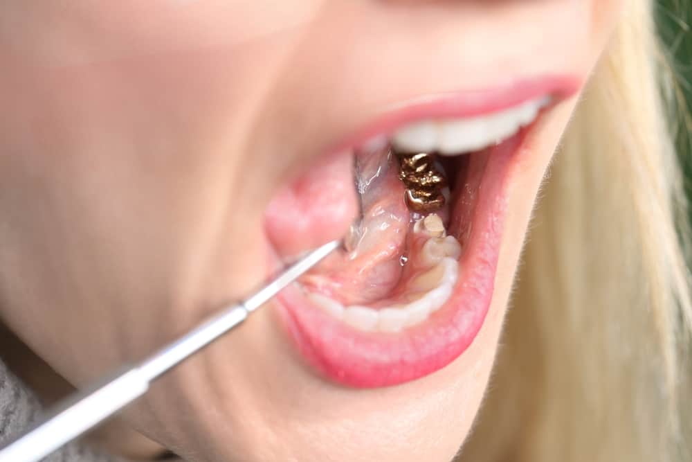 Gold Teeth Applying Procedure