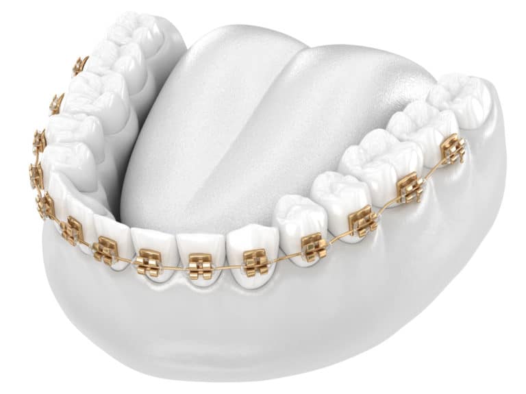 How Much Do Gold Braces Cost?