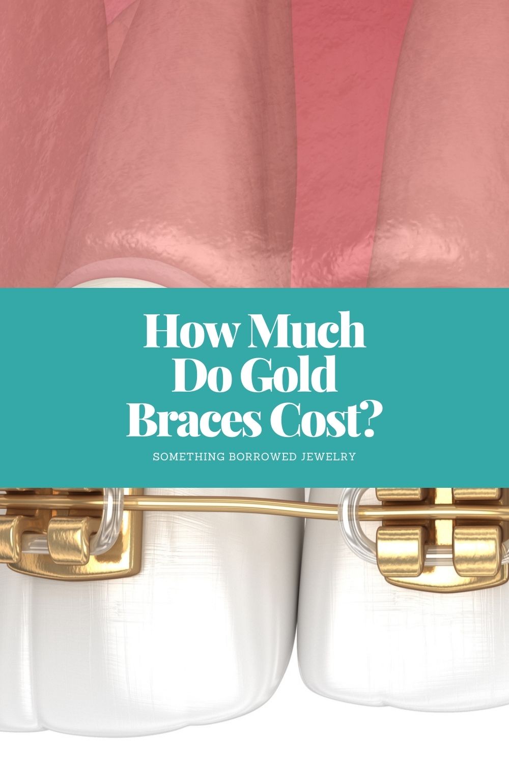 How Much Do Gold Braces Cost pin 2