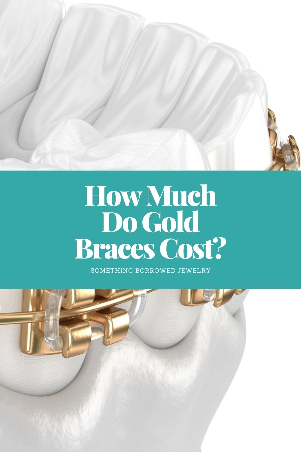 How Much Do Gold Braces Cost pin
