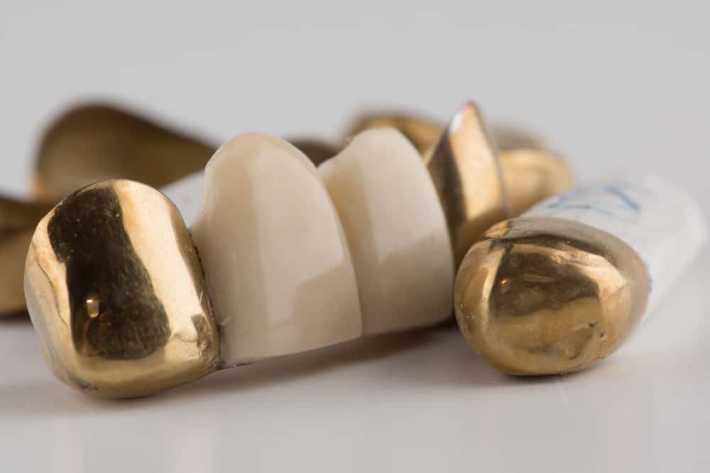 Permanent Gold Teeth Advantages and Disadvantages