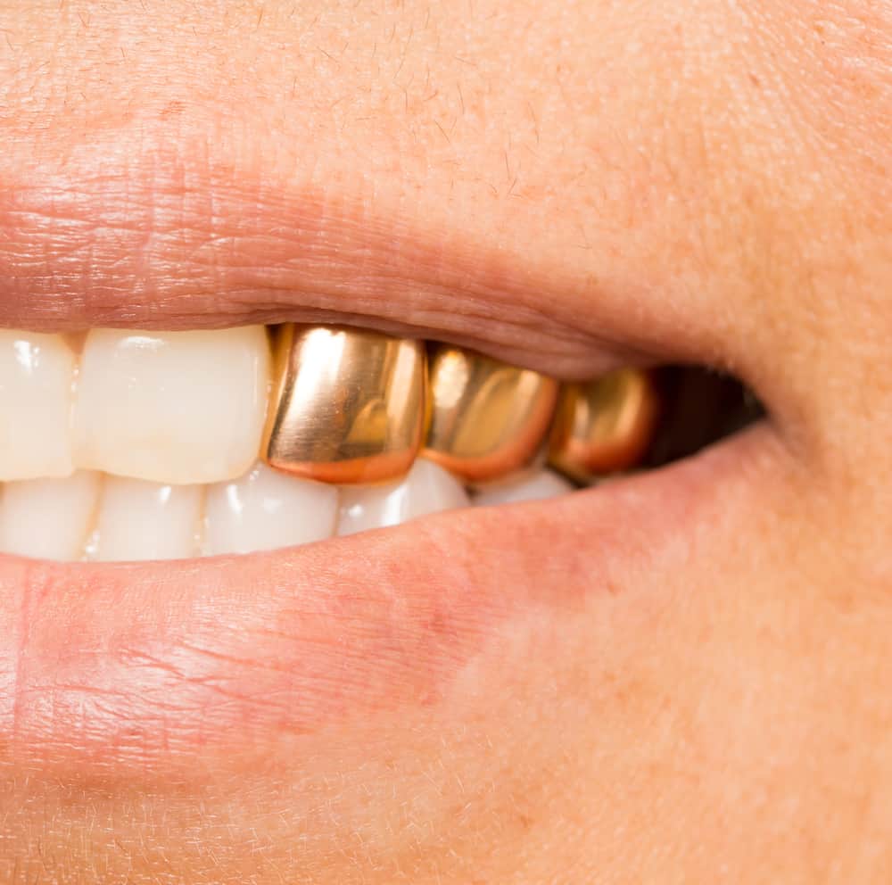 Permanent Gold Teeth Cost