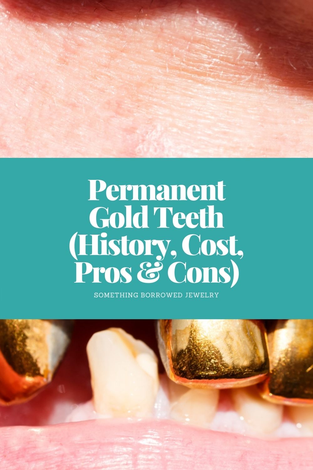 Permanent Gold Teeth (History, Cost, Pros & Cons) pin 2