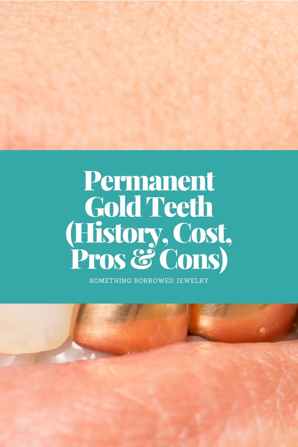 Permanent Gold Teeth (History, Cost, Pros & Cons) pin