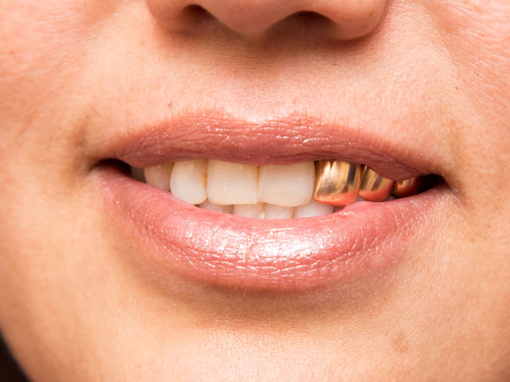 Permanent Gold Teeth