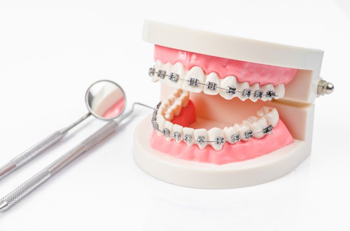 Traditional metal dental braces