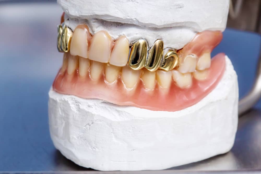 Types of Dental Gold