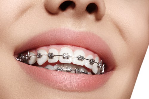 White gold dental braces