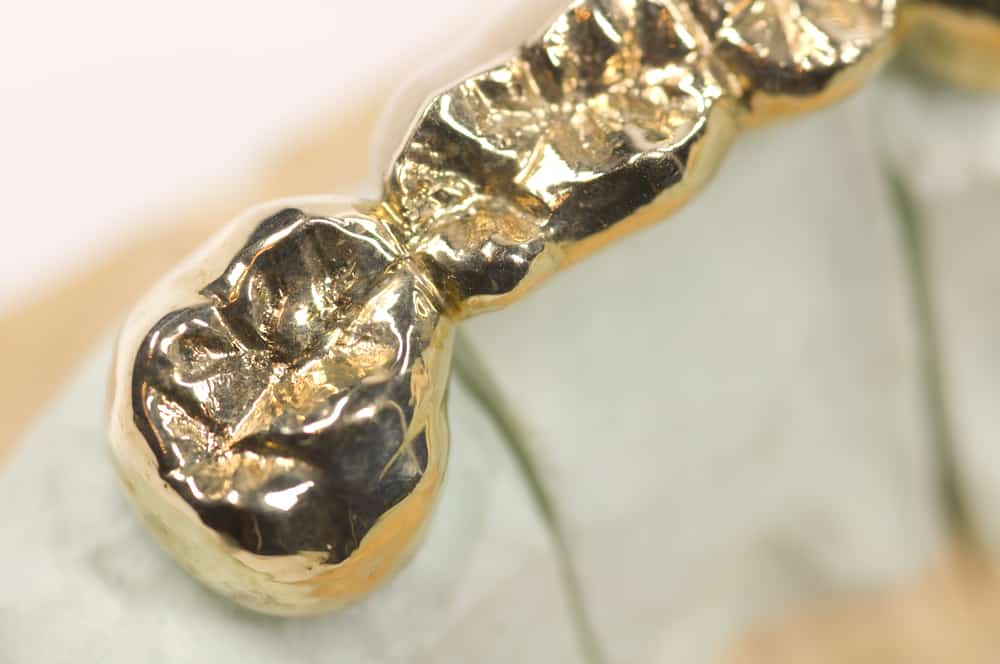 permanent gold teeth cost